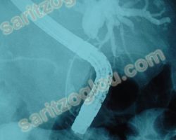 Πλήρης απόφραξη σε όλο το μήκος του χοληδόχου πόρου. Ο ασθενής πάσχει από καρκίνο χοληδόχου – χολαγγειοκαρκίνωμα. Ακτινοσκοπική εικόνα.