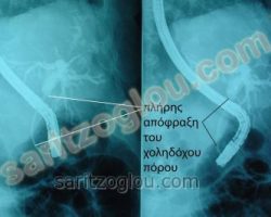 Χολαγγειοκαρκίνωμα. Καρκίνος χοληδόχου πόρου. Ακτινοσκοπική εικόνα.