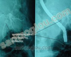 Στον προηγούμενο ασθενή τοποθέτηση μεταλλικού stent, και διάνοιξη του στενεμένου χοληδόχου πόρου. Ακτινοσκοπική εικόνα.