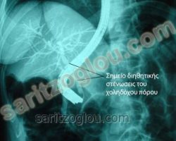 Ασθενής με καρκίνο χοληδόχου πόρου – χολαγγειοκαρκίνωμα. Διακρίνεται η διηθητική στένωση του χοληδόχου πόρου.