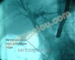 Στον προηγούμενο ασθενή, τοποθέτηση μεταλλικής ενδοπρόθεσης – stent