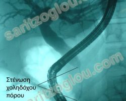 Διηθητική στένωση του τελικού τμήματος του χοληδόχου πόρου από καρκίνο παγκρέατος προκαλεί αποφρακτικό ίκτερο