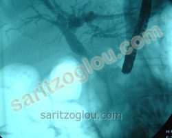Στον προηγούμενο ασθενή τοποθετήθηκε μεταλλικό stent, αποκαθιστώντας την βατότητα του πόρου.