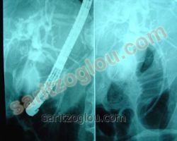 Στον προηγούμενο ασθενή, τοποθετήθηκε stent στον χοληδόχο πόρο προκειμένου να αποφευχθεί η πλήρης στένωση του πόρου και η εμφάνιση ίκτερου. Στην συγκεκριμένη περίπτωση ο ασθενής υποβληθεί σε χειρουργική επέμβαση παγκρεατεκτομής.