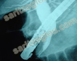 Στον προηγούμενο ασθενή τοποθέτηση μεταλλικού stent με το οποίο αποκαθίσταται η βατότητα του πόρου.