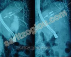 Σε ασθενή με αποφρακτικό ίκτερο λόγο διηθητικής στένωση του κατώτερου τμήματος του χοληδόχου πόρου, από καρκίνο παγκρέατος, έγινε τοποθέτηση μεταλλικού stent.