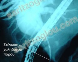 Ασθενής με αποφρακτικό ίκτερο παρουσιάζει πλήρη απόφραξη του τελικού τμήματος του χοληδόχου πόρου, λόγω καρκίνου του παγκρέατος.