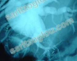 Σε συνέχεια του προηγούμενου ασθενούς, τοποθέτηση μεταλλικού stent αποκαθιστά την απόφραξη του χοληδόχου πόρου.