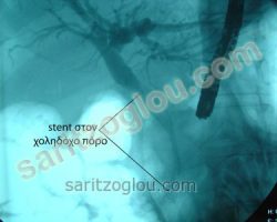 Ασθενές με αποφρακτικό ίκτερο και πυώδη χολαγγειίτιδα, διαγνώστηκε με την μέθοδο της ERCP, η απόφραξη του χοληδόχου πόρου από καρκίνο της κεφαλής παγκρέατος και έγινε τοποθέτηση μεταλλικού stent. Ακτινοσκοπική εικόνα.