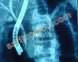 Παρουσία λίθων στον χοληδόχο πόρο. Ο ασθενής παρουσίαζε ίκτερο και χολαγγειίτιδα. Ακτινοσκοπική εικόνα.