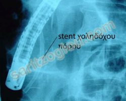 Η προηγούμενη πλαστική ενδοπρόθεση (stent) όπως φαίνεται κατά την ακτινοσκόπηση. Ο ασθενής πάσχει από χειρουργήσιμο καρκίνο παγκρέατος.