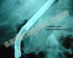 Η προηγούμενη πλαστική ενδοπρόθεση (stent), όπως φαίνεται κατά την ακτινοσκόπηση. Ο ασθενής πάσχει από εξωτερικό χοληφόρο συρίγγιο μετά χειρουργικής επέμβασης λαπαροσκοπικής χολοκυστεκτομής.