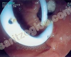 Pig- tail stent τοποθετημένο στον χοληδόχο πόρο εξέρχεται από το φύμα Vater. Ο ασθενής πάσχει από χοληδοχολιθίαση.