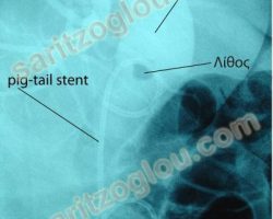 Ακτινοσκοπική εικόνα Pig- tail stent τοποθετημένο στον χοληδόχο πόρο σε ασθενή που πάσχει από χοληδοχολιθίαση. Φαίνεται η παρουσία του λίθου εντός του χοληδόχου πόρου.