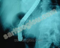 Μεταλλική αυτοδιατεινόμενη μη επικαλυμμένη ενδοπρόθεση (stent) τοποθετημένη στον χοληδόχο πόρο. Ακτινοσκοπική άποψη της προηγούμενης εικόνα στον ίδιο ασθενή.