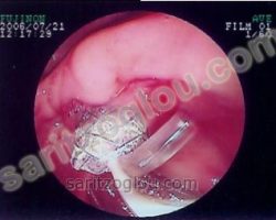 Μεταλλικό stent εξέρχεται του φύματος. Ο ασθενής είχε αποφρακτικό ίκτερο και πυώδη χολαγγειίτιδα λόγω απόφραξης του τελικού άκρου του χοληδόχου πόρου από καρκίνο κεφαλής παγκρέατος. Στην εικόνα φαίνεται να εξέρχεται μεγάλη ποσότητα πύου που είχε συγκεντρωθεί στον χοληδόχο πόρο. (πυώδης χολαγγειίτιδα)
