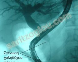 Η ακτινοσκοπική εικόνα του προηγούμενου ασθενούς. Φαίνεται η πλήρης στένωση του τελικού άκρου του χοληδόχου πόρου.