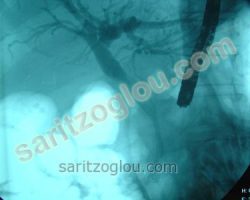 Ακτινοσκοπική εικόνα του προηγούμενου ασθενούς μετά την τοποθέτηση stent το οποίο διέρχεται από την στένωση αποκαθιστώντας την βατότητα του χοληδόχου πόρου.
