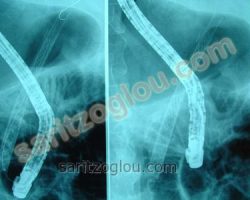 Μεταλλικό stent μετά την τοποθέτηση του στον χοληδόχο πόρο. ακτινοσκοπική απεικόνιση.