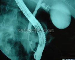 Απεικονίζεται, καθετήρας τύπου μπαλόνι με φουσκωμένο το άκρο του, καθώς εξέρχεται από τον χοληδόχο πόρο για την αφαίρεση μικρού λίθου, από το τελικό του άκρο.