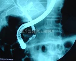 Απεικονίζεται ο καθετήρας μπαλόνι με φουσκωμένο το τελικό του άκρο και κάτω από αυτόν μικρός λίθος στο τελικό άκρο του χοληδόχου πόρου