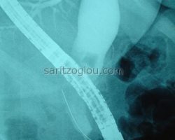 Μεγάλη διάταση του χοληδόχου πόρου λόγω, απόφραξής του, συνεπεία χοληδοχολιθίασης. Απεικονίζεται η παρουσία μεγάλου λίθου.