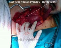 Καρκίνος του παχέος εντέρου με μετάσταση στο μεσεντέριο το λεπτού εντέρου.
