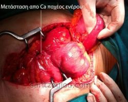 Καρκίνος του παχέος εντέρου με μετάσταση στο λεπτό έντερο.