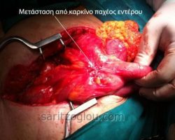 Καρκίνος του παχέος εντέρου με μετάσταση στο λεπτό έντερο.