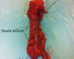 Χειρουργικό παρασκεύασμα δεξιάς κολεκτομής, για καρκίνο παχέος εντέρου. Αναγνωρίζεται ο τελικός ειλεός, το τυφλό, το ανιόν κόλον και τμήμα του εγκαρσίου κόλου.