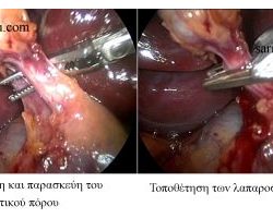 Λαπαροσκοπική χολοκυστεκτομή. Ο κυστικός πόρος διαχωρίζεται από την κυστική αρτηρία και απολινώνεται με λαπαροσκοπικά clips.