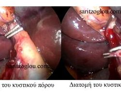 Λαπαροσκοπική χολοκυστεκτομή. Ο κυστικός πόρος της χολής διατέμνεται με λαπαροσκοπικό ψαλίδι