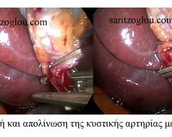 Λαπαροσκοπική χολοκυστεκτομή. Αναγνώριση της κυστικής αρτηρίας και απολίνωση με κλίπς.