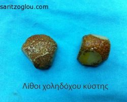 Λίθοι χοληδόχου κύστης.