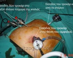 Για την εκτέλεση μια λαπαροσκοπικής χολοκυστεκτομής εισάγονται τέσσερα τροκάρ. Άρα γίνονται 4 μικρές οπές μήκους από 0,5εκ. έως 2εκ.