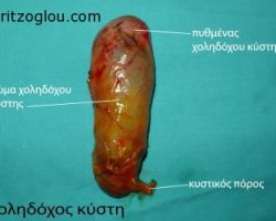 Χοληδόχος κύστη μετά την λαπαροσκοπική της αφαίρεση από τον ασθενή.