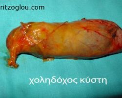 Χοληδόχος κύστη μετά την λαπαροσκοπική της αφαίρεση από τον ασθενή.