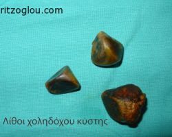 Λίθοι χοληδόχου κύστης