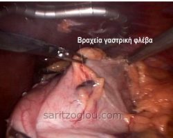 Η διατομή των βραχέων γαστρικών φλεβών γίνεται τελείως αναίμακτα με την χρήση του ψαλιδιού υπερήχων.