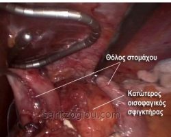 Ο θόλος του στομάχου έχει περάσει πίσω από το τελικό τμήμα του οισοφάγου (κοιλιακός οισοφάγος) έχοντας τυλίξει πλήρως την οπίσθια επιφάνεια του.