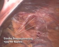 Φαίνονται τα σκέλη του διαφράγματος και η μεγάλη τρύπα (κήλη του διαφράγματος) μέσα από την οποία περνάει στην θωρακική κοιλότητα ο κατώτερος οισοφάγος και το στομάχι.