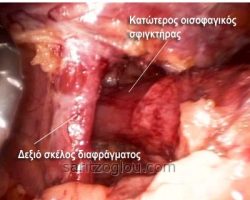 Μετά την χειρουργική παρασκευή της περιοχής φαίνεται ο κατώτερος οισογάγος το οισοφαγικό τρήμα του διαφράγματος και το δεξιό σκέλος. Δείτε πόσο διευρισμένο είναι το οισοφαγικό τρήμα του διαφράγματος.