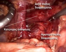 Διακρίνεται το δεξιό σκέλος του διαφράγματος, ο κατώτερος οισοφάγος και ο οισοφαγικός σφιγκτήρας.