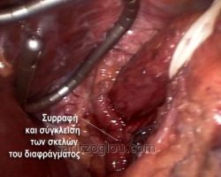 Με την σύγκλειση των σκελών του διαφράγματος επιτυγχάνεται η ανάταξη της διαφραγματοκήλης και εμποδίζεται η παθολογική είσοδος του στομάχου δια μέσου του οισοφαγικού τρήματος προς τη θωρακική κοιλότητα.