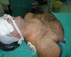 Μετά την διασωλήνωση, ο ασθενής τοποθετείται σε ειδική θέση με τον αυχένα σε υπερέκταση
