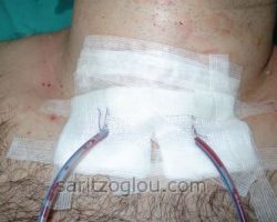 Τις περισσότερες φορές η τομή επιλέγεται να γίνει σε σημείο φυσιολογικής ρυτίδωσης του δέρματος.