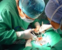 Η θυρεοειδεκτομή εκτελείται με την χρήση τεχνολογικά εξελιγμένων χειρουργικών εργαλείων, όπως για παράδειγμα το ψαλίδι υπερήχων, με το οποίο εξασφαλίζεται ελαχιστοποίηση των ιστικών βλαβών.