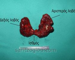 Ο θυρεοειδής αδένας όπως φαίνεται μετά τη πλήρη αφαίρεση του.
