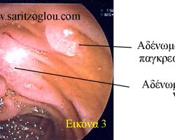 Εικόνα 3. Ανάπτυξη δύο αδενωμάτων. Το πρώτο αναπτύσσετε στην εκβολή του ελάσσονα παγκρεατικού πόρου και το δεύτερο αναπτύσσετε στο φύμα Vater. αδένωμα φύματος vater