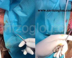 Εικόνα 2. Αιμορροϊδεκτομή με ψαλίδι υπερήχων.
Το ψαλίδι υπερήχων κόβει την αιμορροΐδα αναίμακτα χωρίς βλάβη των υγιών ιστών.